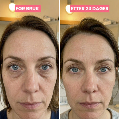 SkinLift | Mikrostrøm &amp; Rødlys - Klinisk Dokumentert
