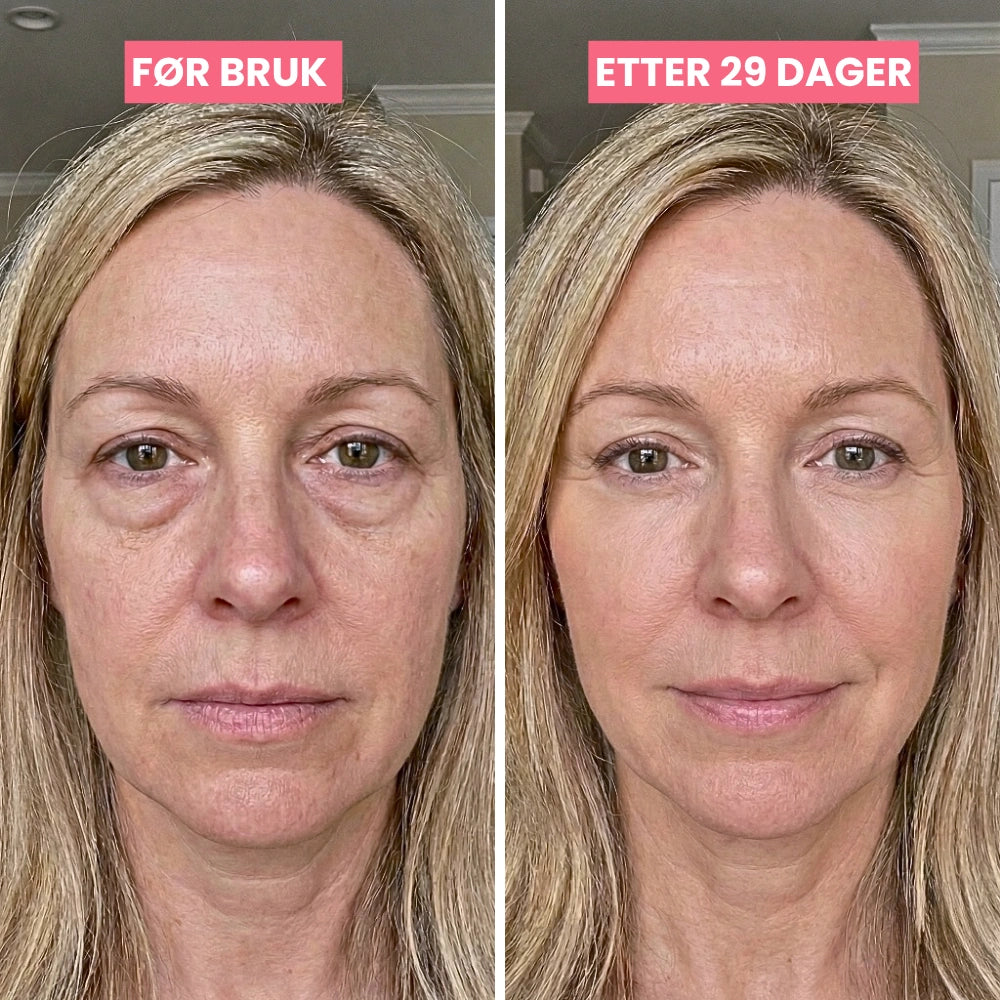 SkinLift | Mikrostrøm &amp; Rødlys - Klinisk Dokumentert