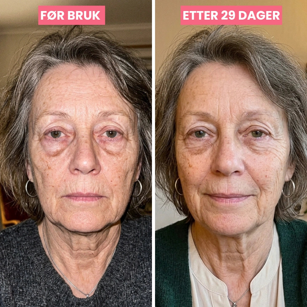 SkinLift | Mikrostrøm &amp; Rødlys - Klinisk Dokumentert