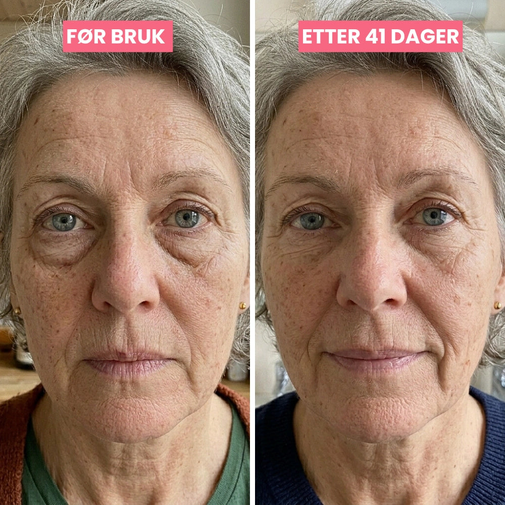 SkinLift | Mikrostrøm &amp; Rødlys - Klinisk Dokumentert