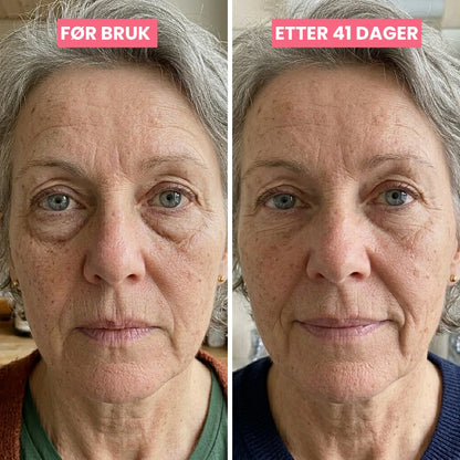 SkinLift | Mikrostrøm &amp; Rødlys - Klinisk Dokumentert